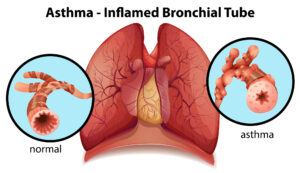 A diagram showing an inflamed bronchial tube from asthma. 