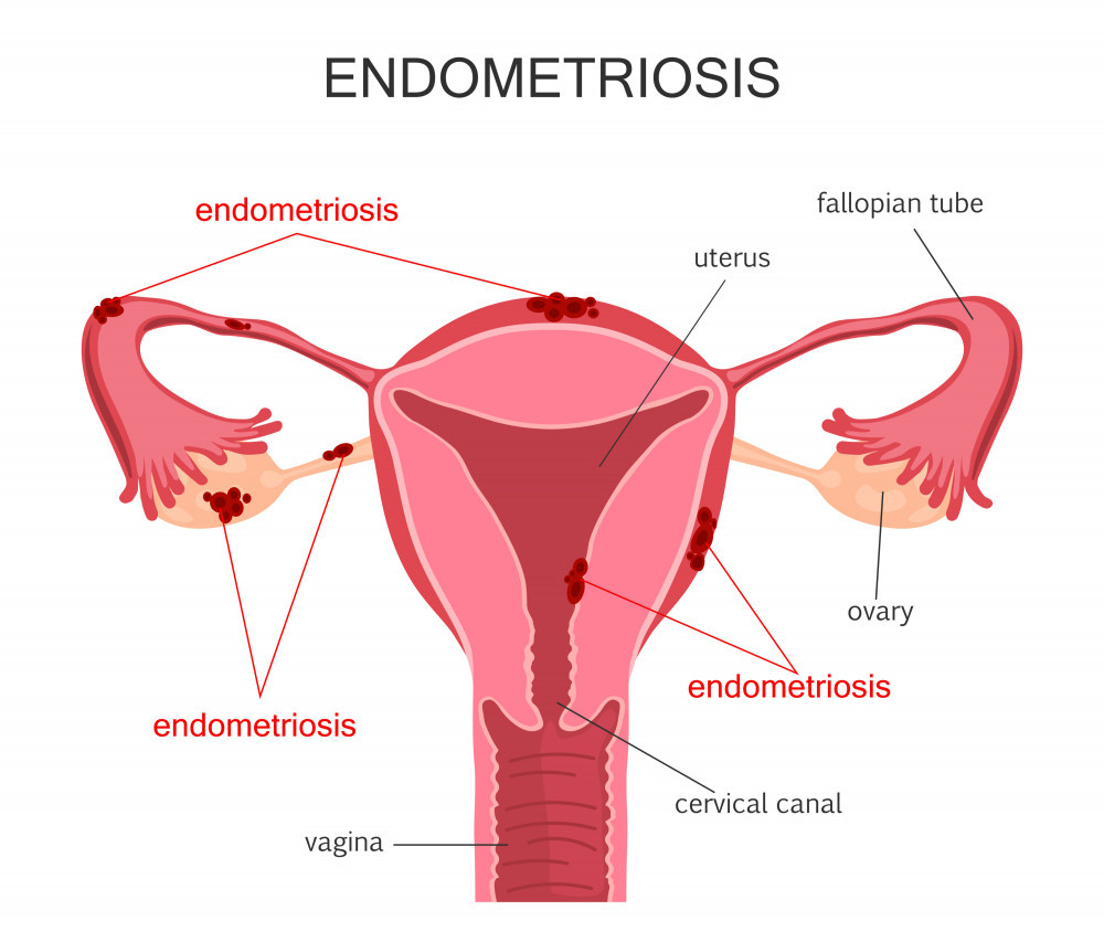 A cartoon diagram displaying the female reproductive organs and how endometrial tissue can grow outside of the uterus. 