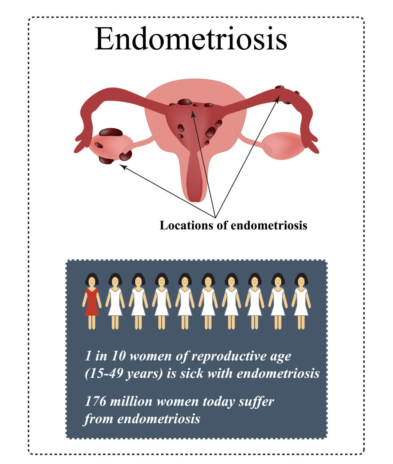 All About Endometriosis: Symptoms, Causes, and Treatment Options