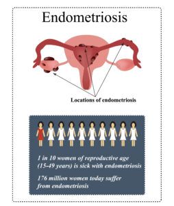 A diagram illustrating where endometriosis tissue grows outside the uterus and representing the prevalence of endometriosis. 