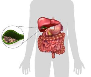 A diagram showing the presence of gallstones in a human gallbladder. 