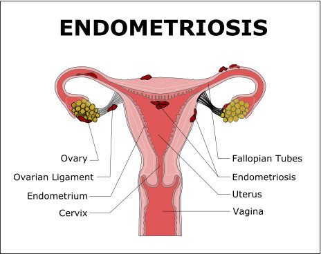 A diagram displaying the tissue that grows outside of the uterus with endometriosis.