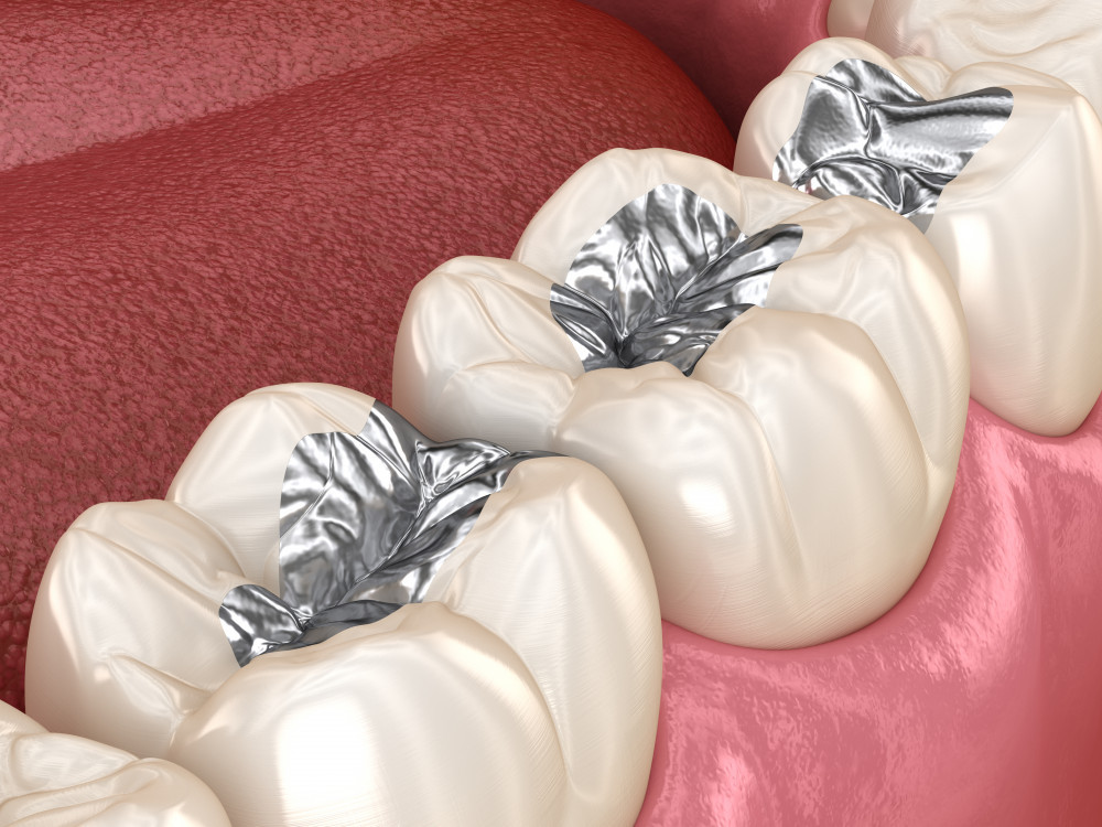 Teeth with mercury amalgam fillings in them.