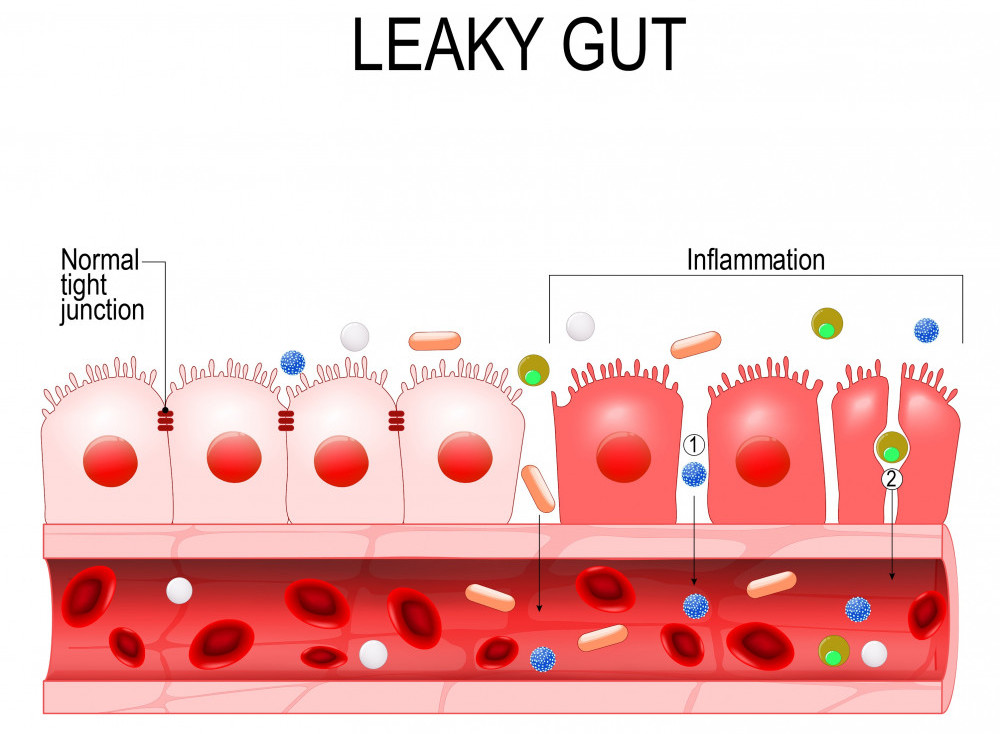 A diagram displaying leaky gut.
